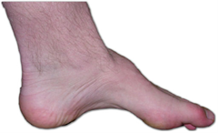 CMT foot